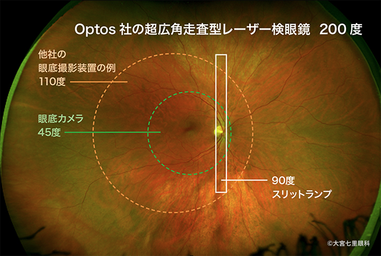 ptos社の超広角走査型レーザー検眼鏡での広角眼底写真