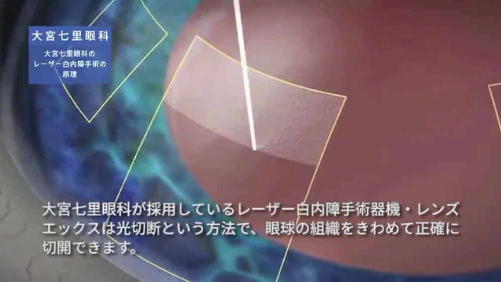 フェムトセカンドレーザー白内障手術 超短時間パルスの精密な切開