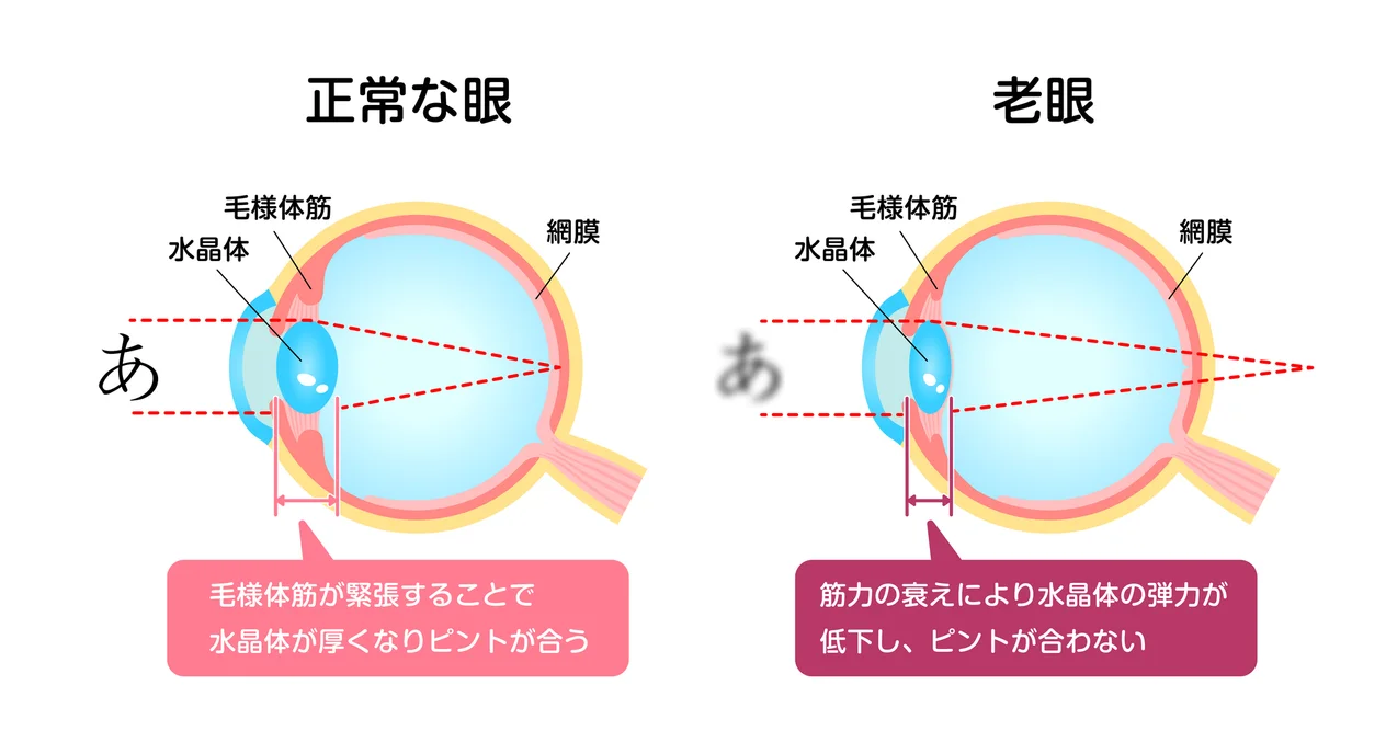 正常な眼と老眼のピント調節の比較図