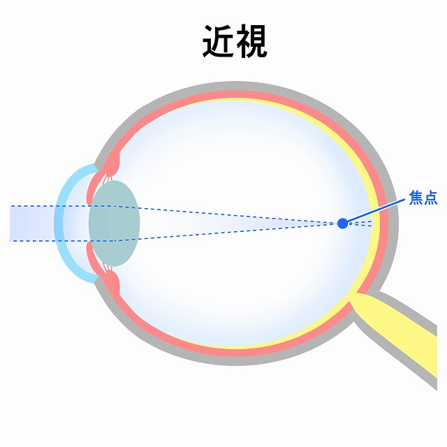 近視