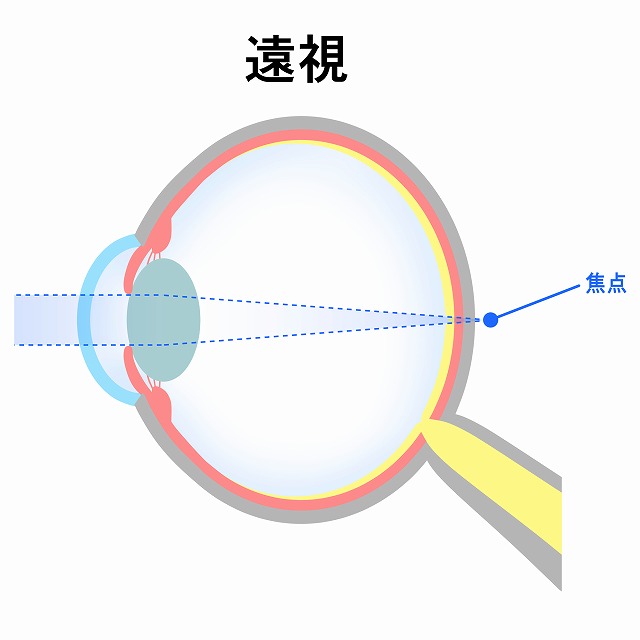 遠視