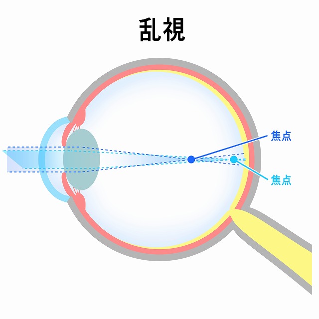 乱視